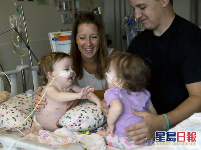 一岁连体双胞胎女婴历11小时手术成功分离。AP图片