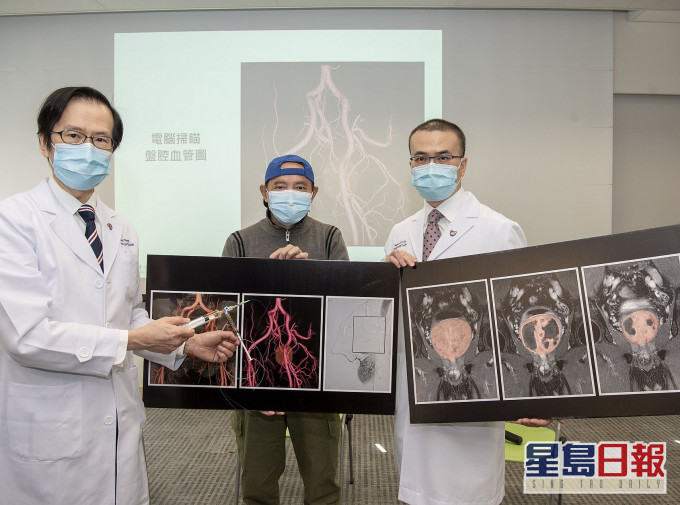 中大發現能預測「前列腺動脈栓塞術」成效的指標。中大圖片