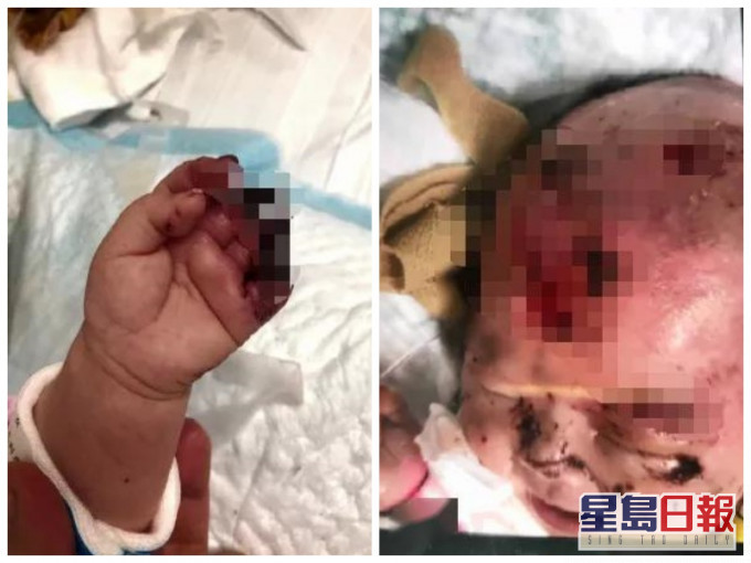 女嬰頭皮被咬至見骨。網圖
