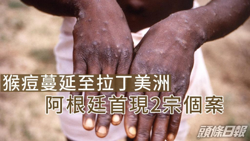歐洲疾控中心強調猴痘的傳染性較新冠病毒低。REUTERS