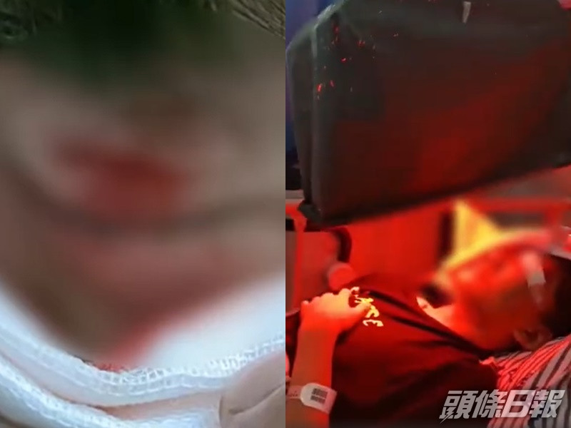 男生左眼被班主任打傷留醫。網圖