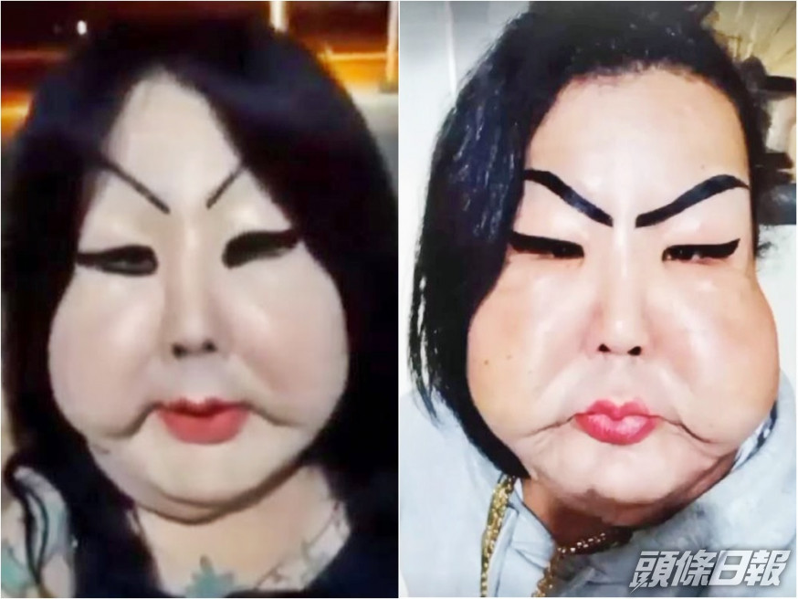 奧利韋拉整容失敗,導致臉頰腫脹。網圖