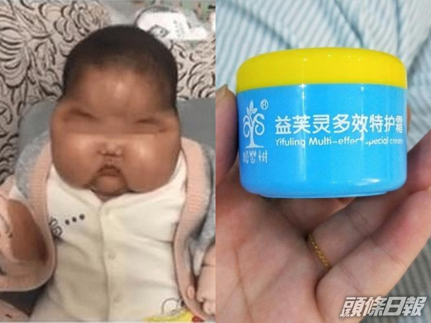 歐艾嬰童健康護理用品有限公司生產的抑菌霜因含類固醇,被吊銷牌照。