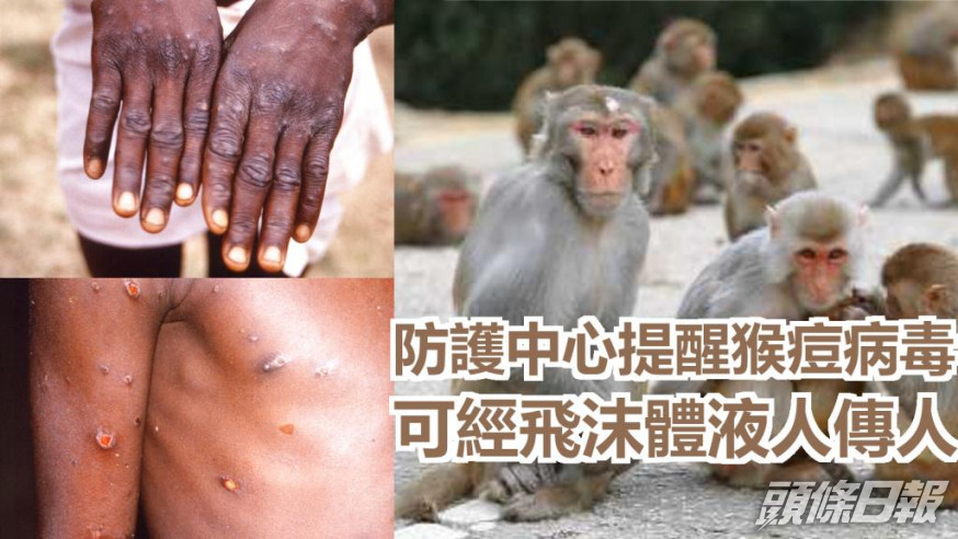 歐美多國的猴痘疫情持續蔓延。