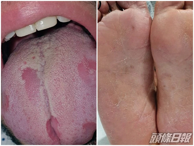 西班牙有研究團隊發現,確診者出現「新冠舌頭」病徵,手掌及腳掌均起紅點、出疹,甚至脫皮。網圖