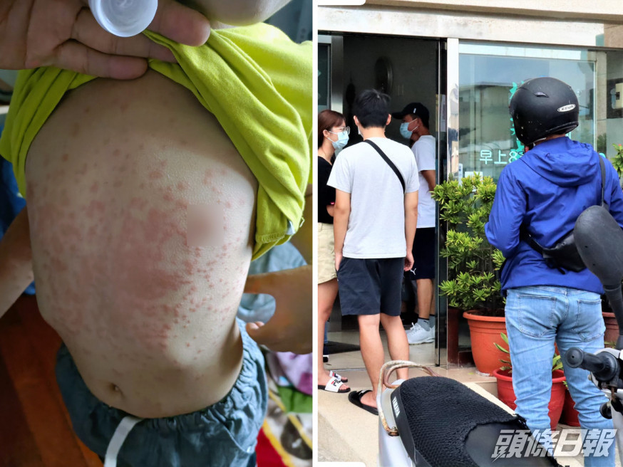 患者皮膚會出現紅疹及痕癢。(活力澎湖公益平台FB圖片)