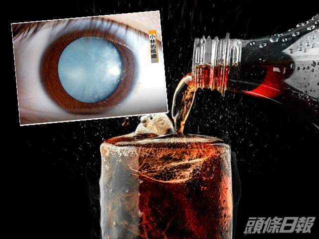 小林長期可樂當水飲,以致右眼瞳孔變成淡藍色,接近完全失明。網圖