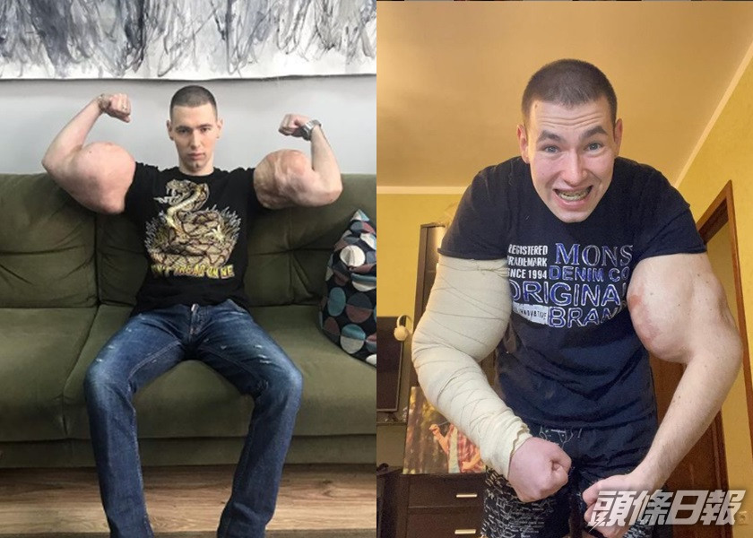 特雷辛將凡士林打進手臂變成巨肌,如今需面對多種後遺症。
kirill_tereshin_ruki_bazuki instagram圖片