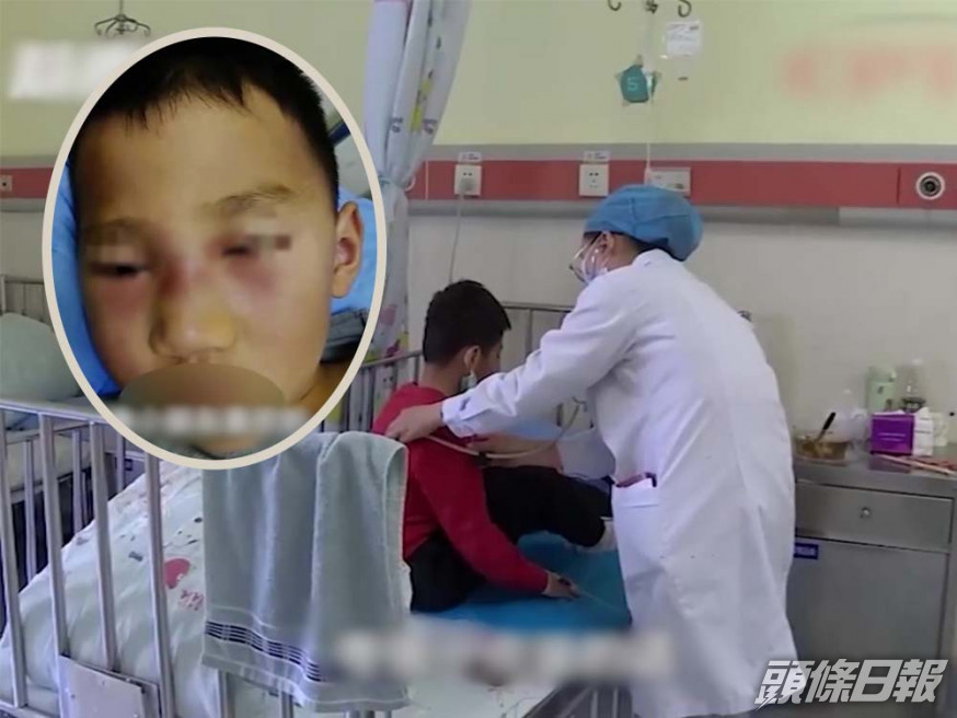 滔滔面部出現蜂窩組織炎,醫生稱他腫得像鹹蛋超人。互聯網圖片