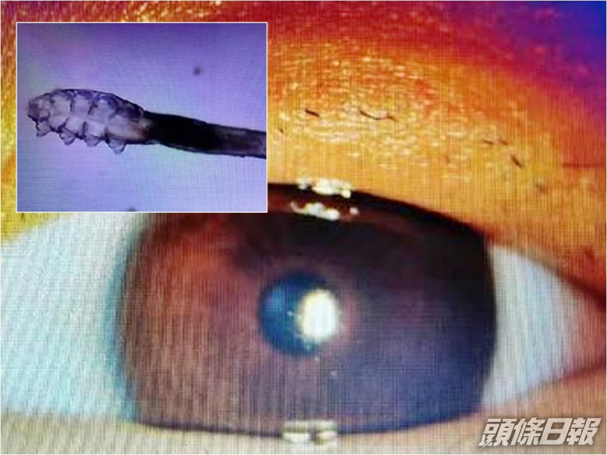 溫州一名女子植假睫毛後,發現根部長滿一條條蟎蟲。網圖