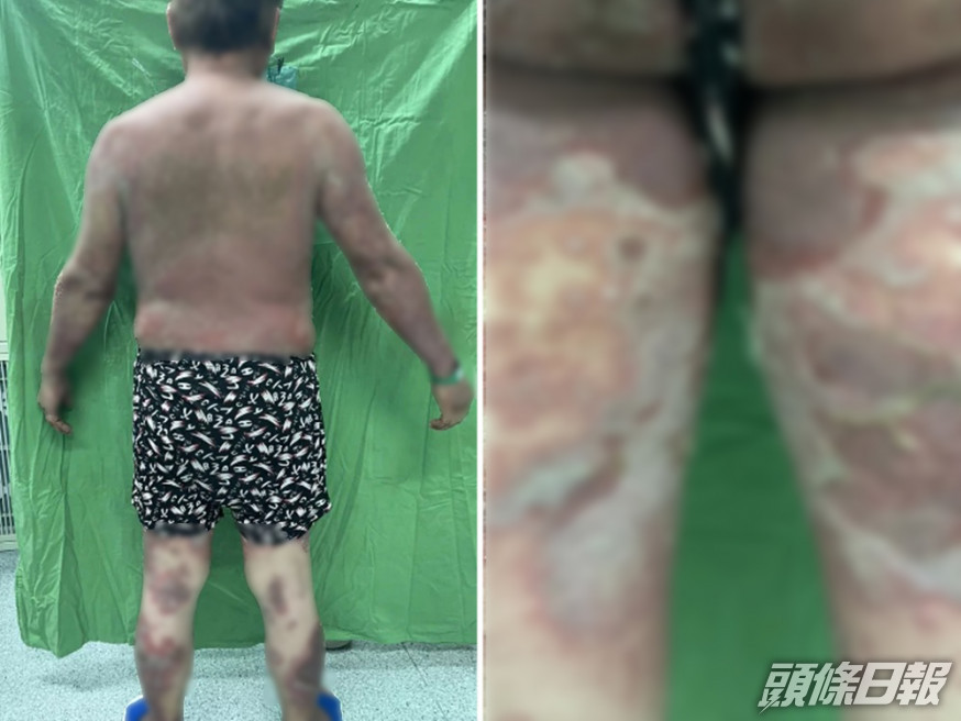 澎湖一名70歲男子接種新冠疫苗後,出現全身脫皮不良反應。網圖