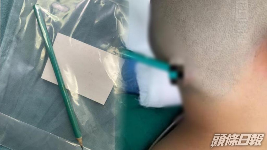 鉛筆被插入後腦勺。互聯網圖片