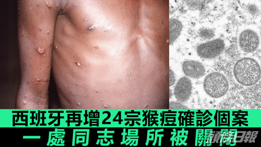 西班牙迄今有30宗猴痘個案。美聯社圖片