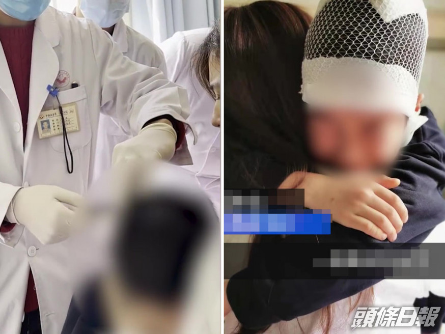 9歲男童被老師扯頭髮拖行致頭皮頭骨分離。
