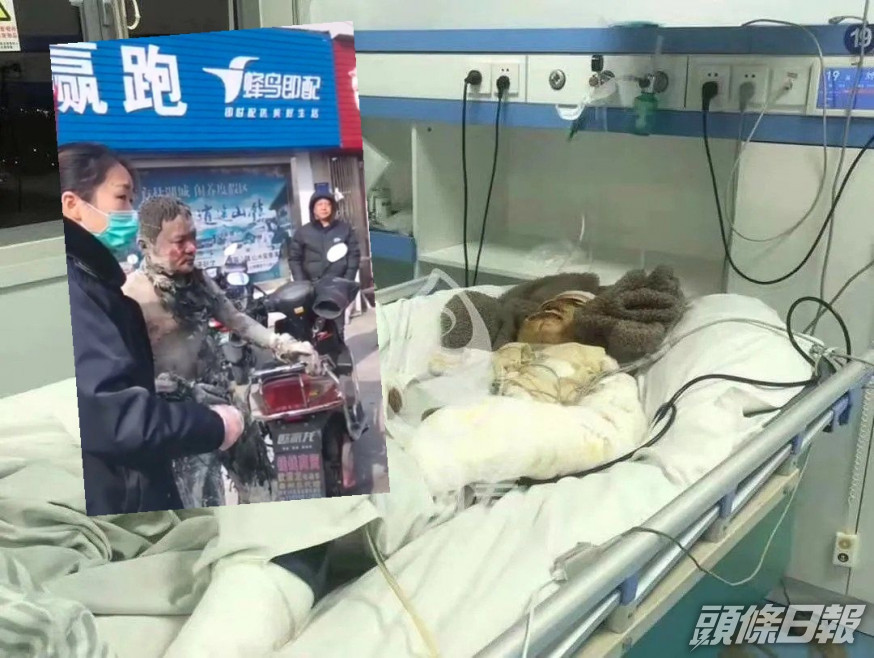 外賣員劉進全身燒傷面積達8成。網圖
