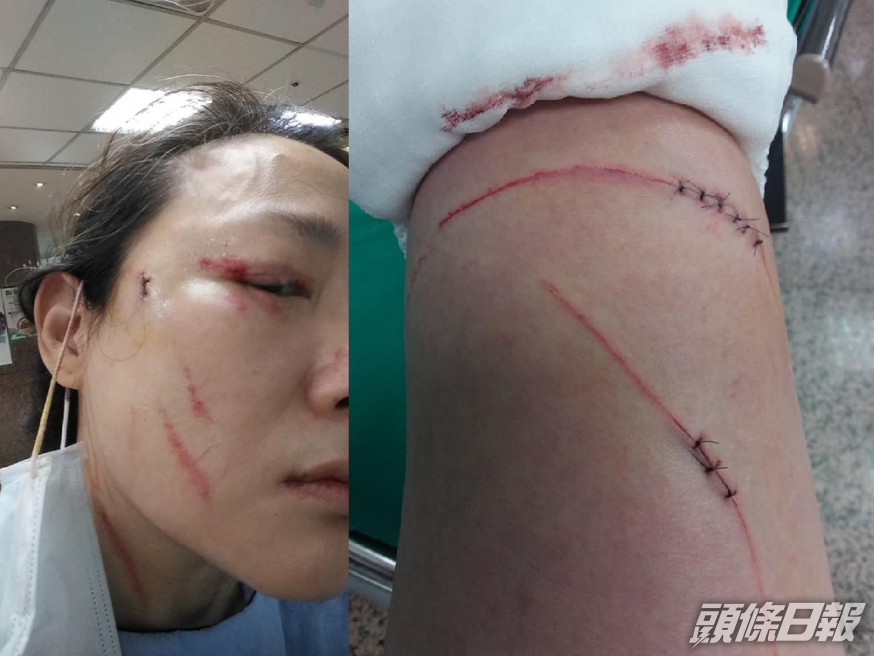 台北一名女子因提醒鄰居戴口罩而遭對方斬傷,頭部及手臂均有多個傷口,血迹斑斑。 (女事主facebook)