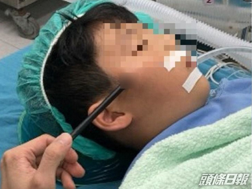 兄持玩具弓箭誤射7歲弟,箭插入臉。(網圖)
