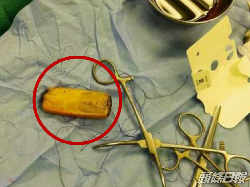 埃及男腹痛入院,醫生從肚裏拿出半年前吞下手機。網圖