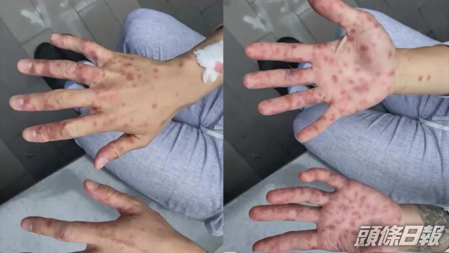 猴痘病患者。網上圖片