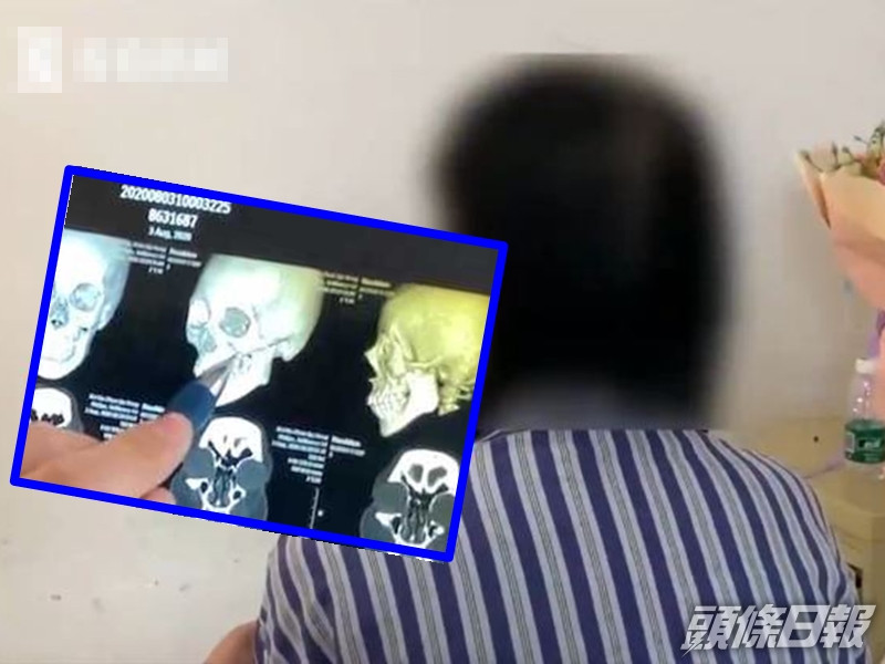 遼寧瀋陽一名23歲的姓劉女子,在水上樂園不慎與人發生碰撞,導致左臉顴骨4處骨折,險些毀容。網圖