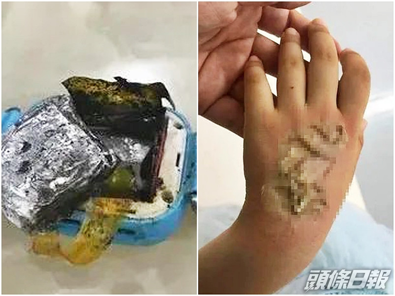 福建一名女童所佩戴的兒童智能手表突然自燃,導致其手背三級燒傷。網圖
