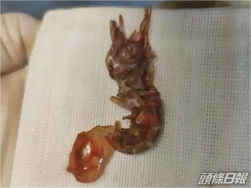 14歲少年將小龍蝦塞進肛門。網圖