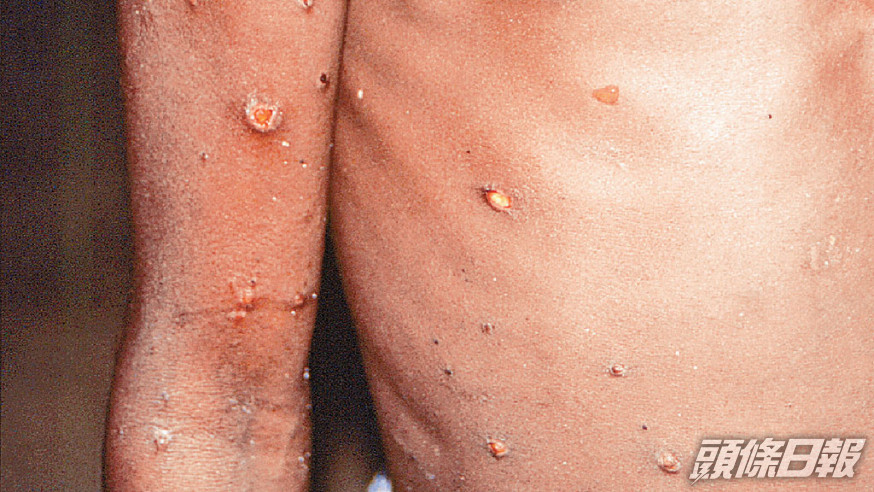 本港出現首宗猴痘輸入個案，男患者情況穩定。 ap資料圖片