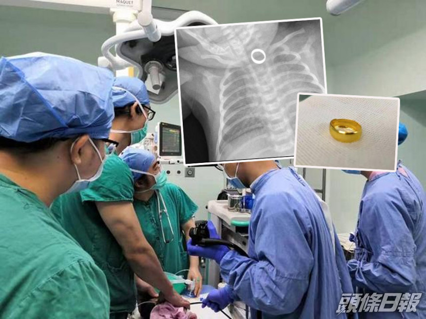 廣東1歲女嬰誤吞金戒指卡食道,醫生用超細胃鏡拆彈。(網圖)