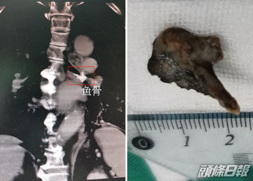 東莞一間醫院近日為78歲老翁進行手術,取出一塊卡在氣管多年魚骨。網圖