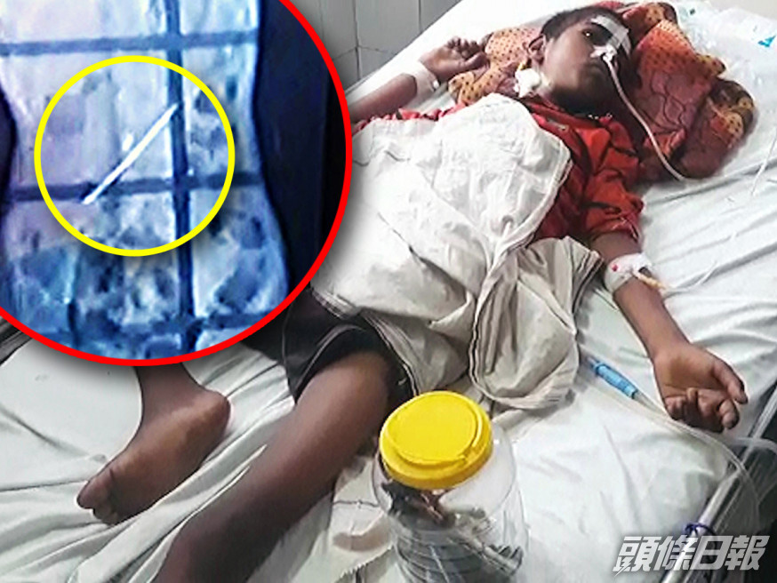 北方邦少年哈里斯為治異食習慣吞食牙刷,終腹痛送院治理。網圖