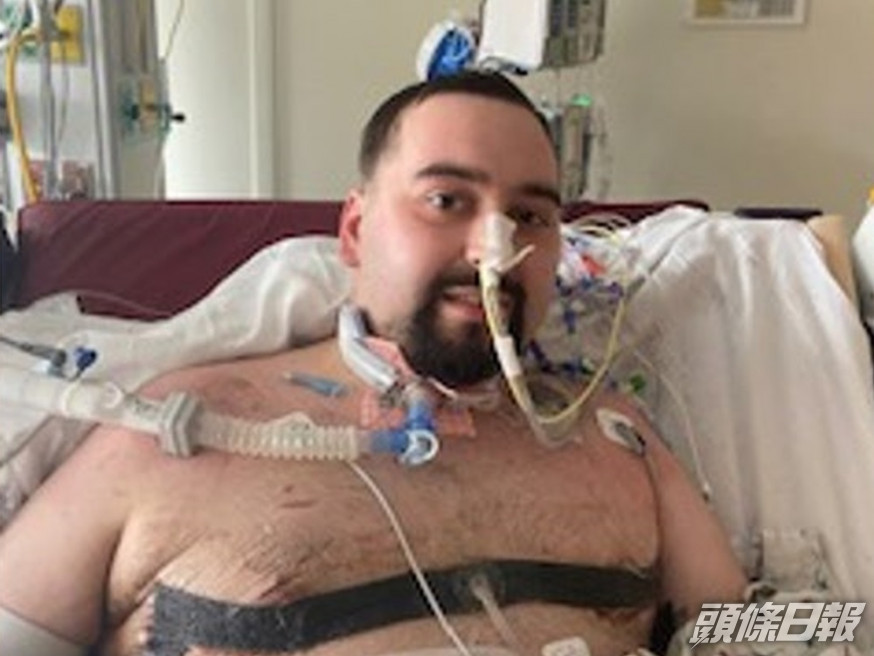 美國24歲男子Blaze拒打新冠疫苗後卻不幸染疫,須接受雙肺移植手術以保命。網圖