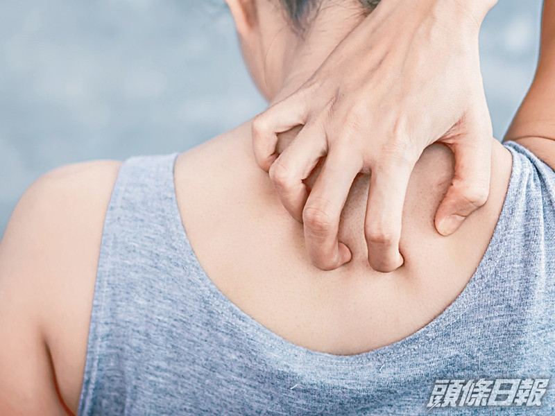 銀屑病女性困擾較嚴重。
