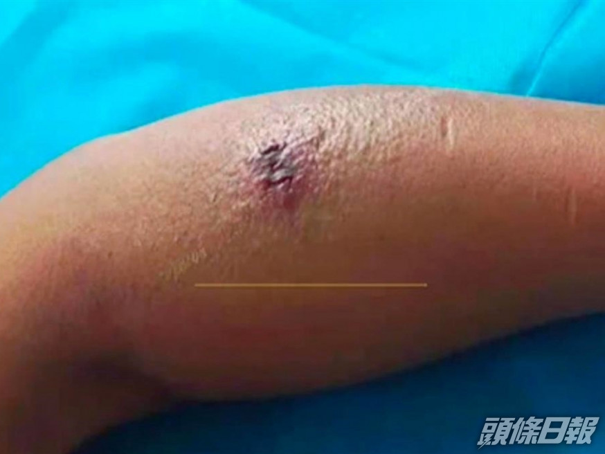 男子被蚊咬後手臂潰爛壞死。網圖