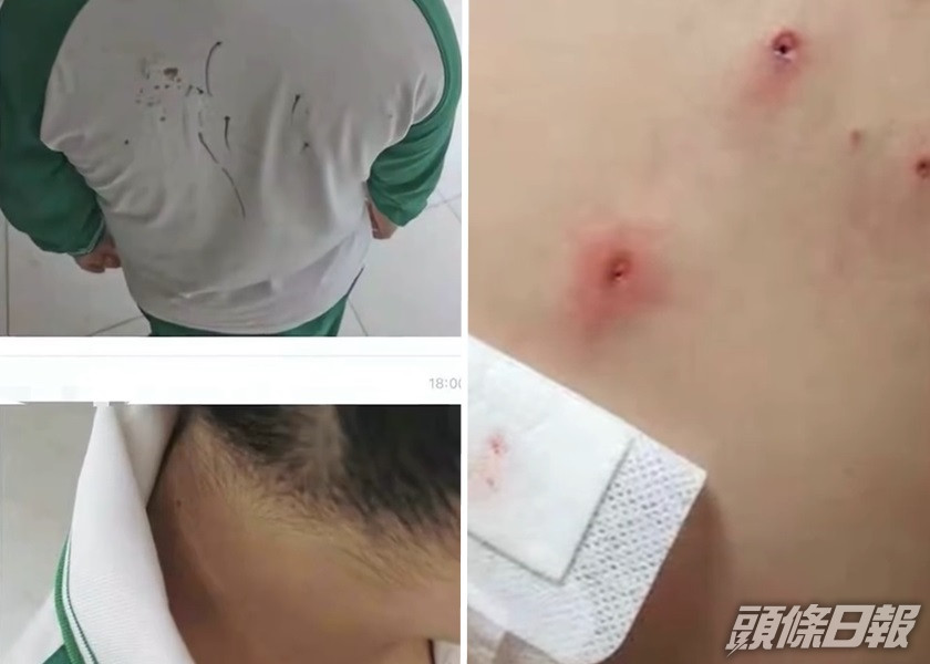 廣州一名小一生疑被同學欺凌,用鉛筆刺傷身體多處。影片截圖