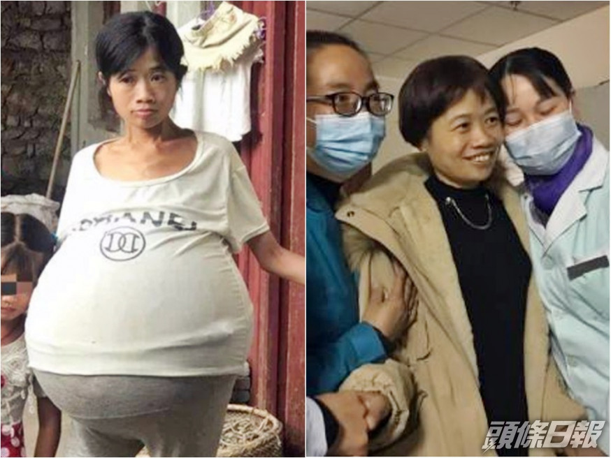貴州巨肚媽媽手術後成功回復正常人的體重。網圖