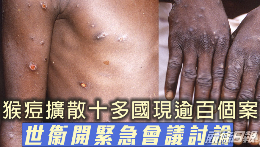 猴痘擴散十多國現逾百確診及疑似個案,世衞開緊急會議討論情況。AP