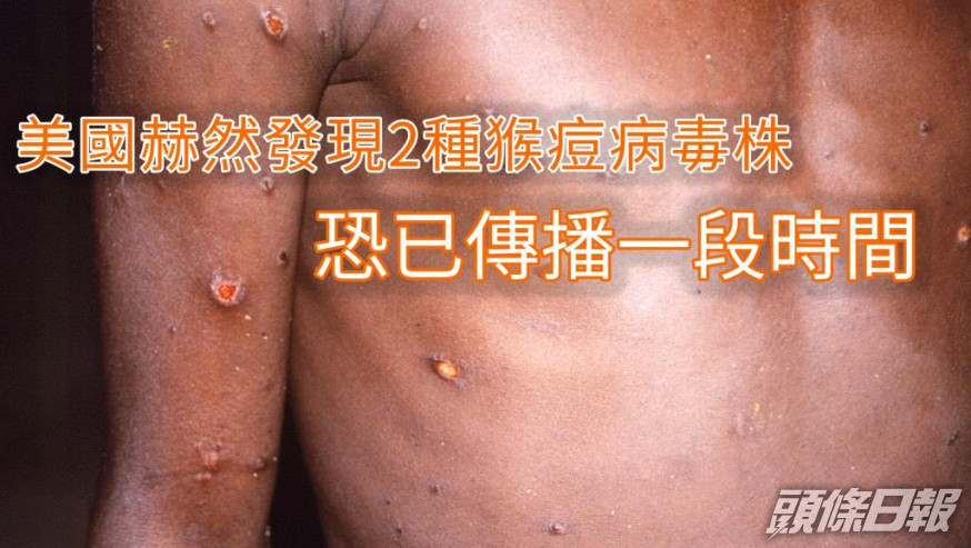 全球發現逾700宗猴痘病例。AP
