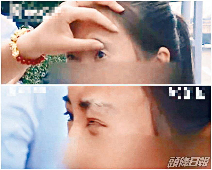 ■山西一女孩眼部整容失敗,左眼睜不開閉不上。