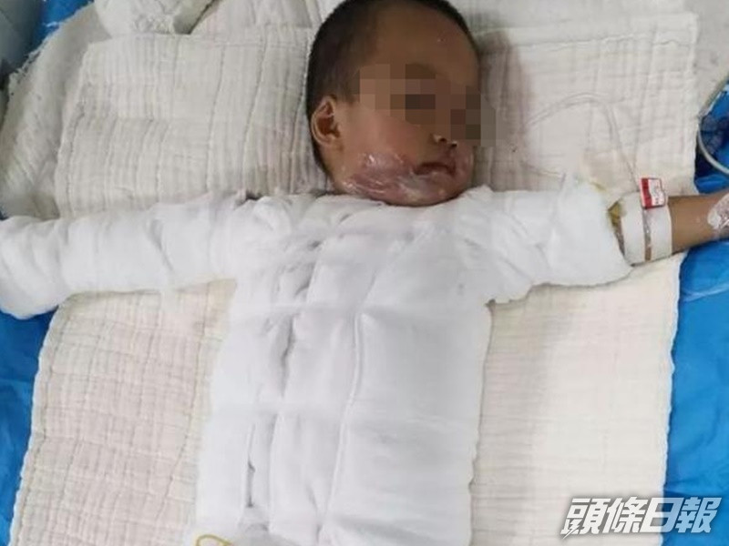 小雷爸不慎跌入滾燙油桶內嚴重燒傷。網圖