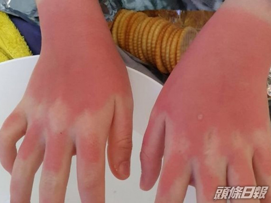 12歲女參加完學校的水上活動日後,雙手被曬傷,非常紅燙。