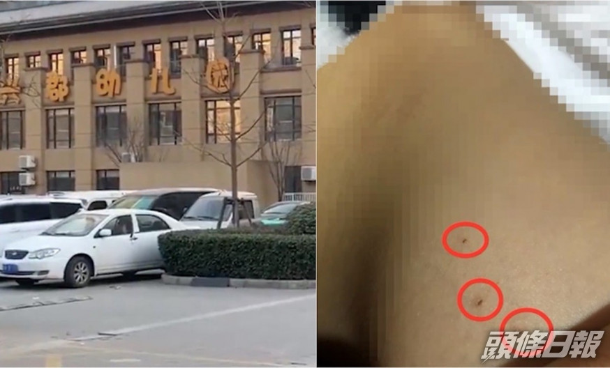內地一名3歲女童放學後被母親發現身上有疑似針孔。網圖