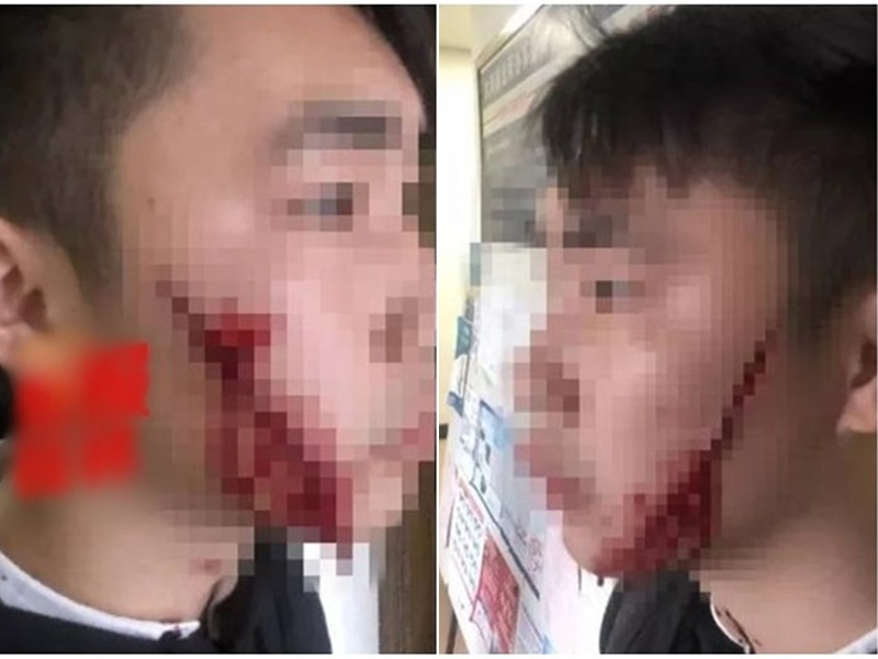 廣西女鎅傷男友臉。網上圖片
