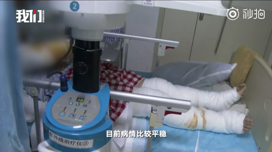 深圳婦在家煮飯突被閃電擊中致四肢三級燒傷。 影片截圖