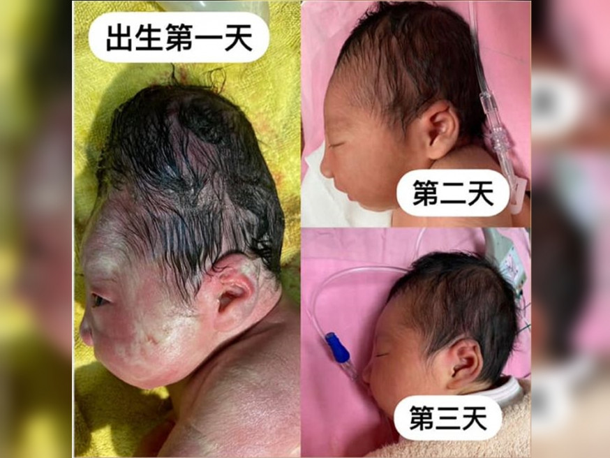 台灣嫲嫲驚覺初生孫女「頭顱好長」 。台北長庚醫院婦產科FB圖片