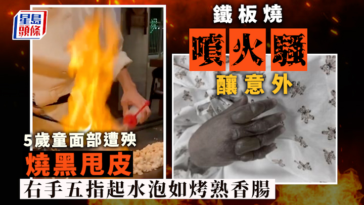 日式鐵板燒「噴火騷」釀意外  5歲童面部遭殃燒黑甩皮  手指起水泡如烤熟香腸