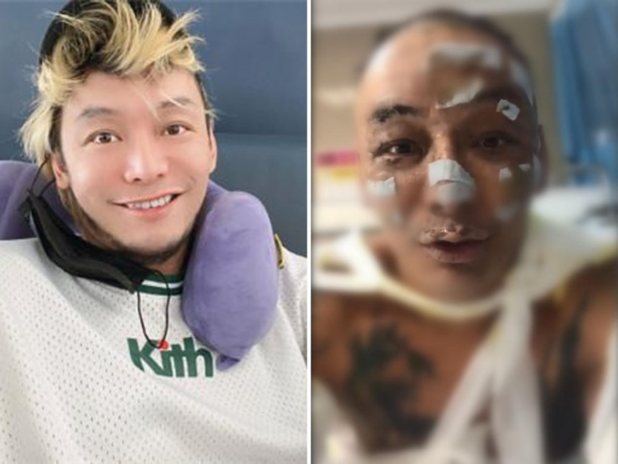 內地歌手徐真真全身二級深度燒傷。