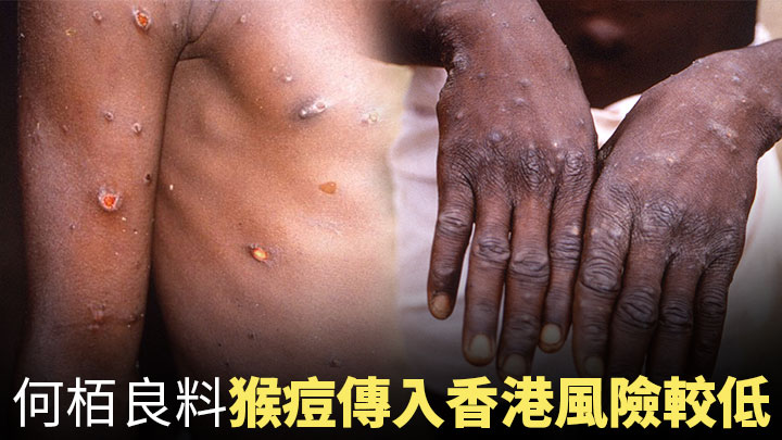 猴痘傳染性不高 何栢良料傳入香港風險較低