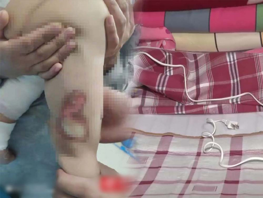 1歲男孩下肢被電燒傷。互聯網圖片