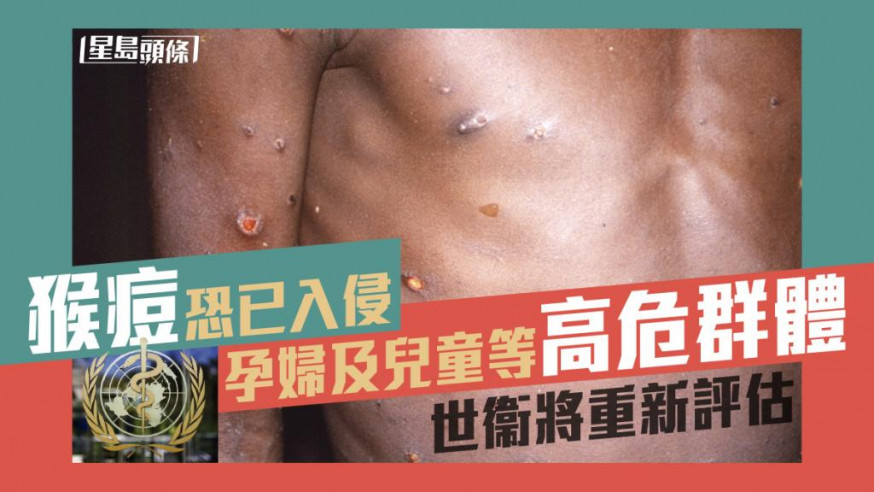 猴痘恐已入侵孕婦及兒童等高危群體,世衞將重新評估疫情。
