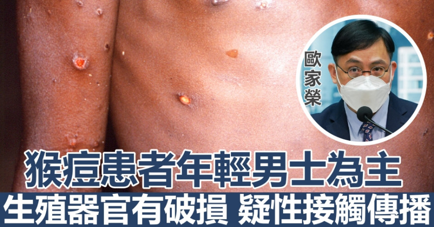 歐家榮(細圖)料猴痘對香港風險較低。